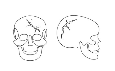 Head. Injury. Scull. Skull fracture. Crack