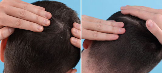 Fototapeta premium Man showing hair before and after dandruff treatment on light blue background, collage