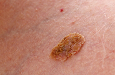 Benign Melanoma