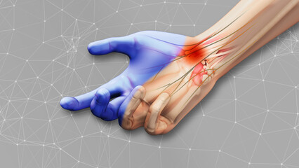 Carpal tunnel syndrome with plexus background