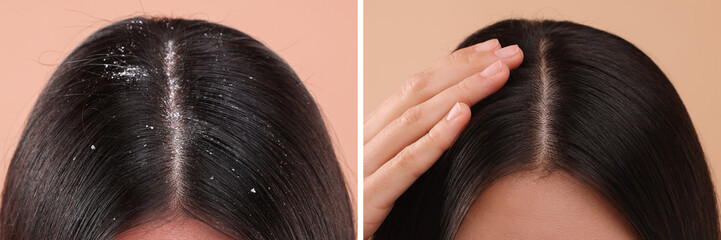 Woman showing hair before and after dandruff treatment on beige background, collage