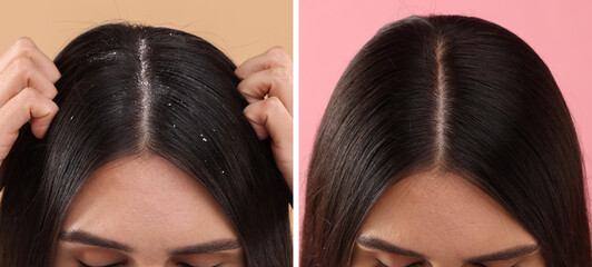 Woman showing hair before and after dandruff treatment on color backgrounds, collage