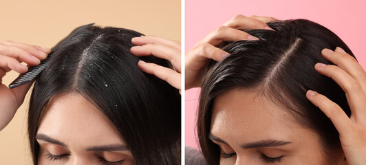 Woman showing hair before and after dandruff treatment on color backgrounds, collage - obrazy, fototapety, plakaty