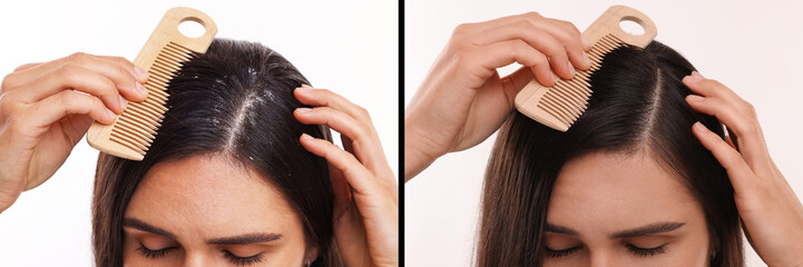 Woman showing hair before and after dandruff treatment on white background, collage