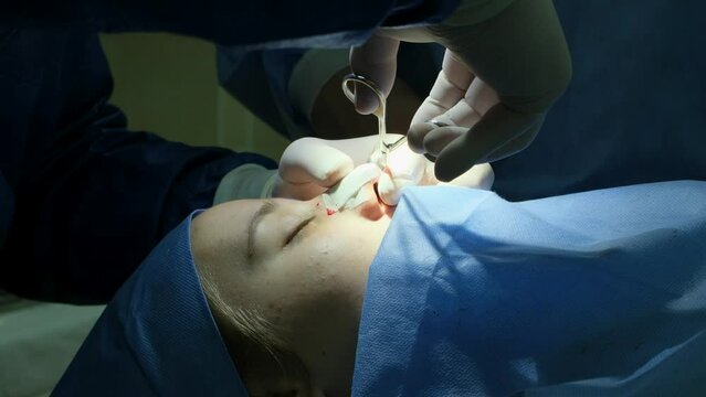 Plaster application on the nose of a patient's girl after endoscopy septoplasty surgery. Slow motion, close-up