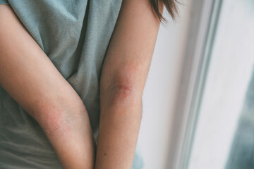 a girl shows her combed dry skin on the bend of her elbow, redness, roughness, itching from atopic...