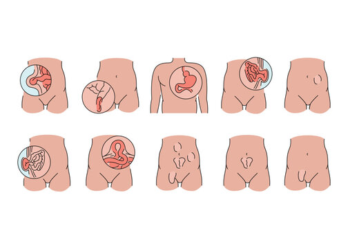 Hernias line icons set. Vector isolated element.