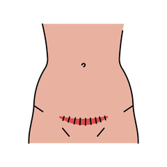 Pfannenstiel incision line icon. Abdominal incisions.