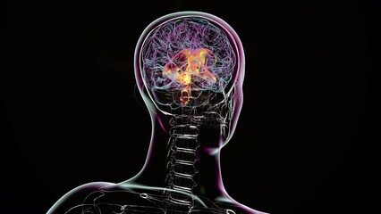 A 3D scientific animation depicting enlarged lateral and third ventricles of the brain (hydrocephalus), caused by a brain tumor compressing the cerebral aqueduct.