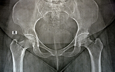 Plain X ray reveals bilateral Avascular necrosis (AVN) of the femoral head more in the left side, a...