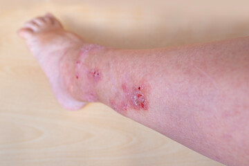 allergic reactions, itchy skin on leg, hives and other skin manifestations, Foot and Leg...