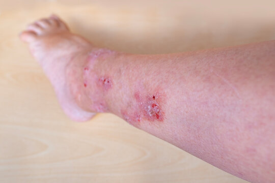 allergic reactions, itchy skin on leg, hives and other skin manifestations, Foot and Leg Conditions, skin problems on general physical and emotional well-being