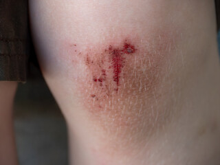 Bleeding Knee Injury Close-Up