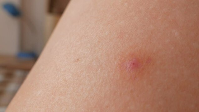 mosquito bites ticks on woman's legs, big red spots on skin, Lyme disease