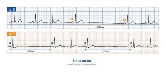 When sinus arrest occurs, the electrocardiogram will show a long P-P interval, which is not multiples of the basal sinus cycle, including physiological and pathological reasons.