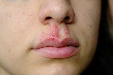 close-up of a woman with herpes on her lip: vesicle and blister