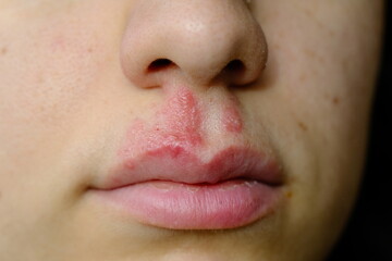 close-up of a woman with herpes on her lip: vesicle and blister