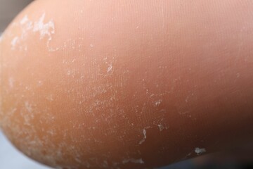 Fototapeta premium Woman with dry skin on foot, closeup