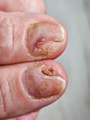 Hands and fingers with psoriatic onychodystrophy or psoriatic nails. fungal infection of nails....