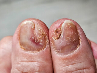 Hands and fingers with psoriatic onychodystrophy or psoriatic nails. fungal infection of nails....