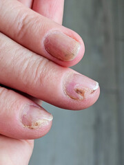 Hands and fingers with psoriatic onychodystrophy or psoriatic nails. fungal infection of nails. Deformed human nails. Damaged yellow human nail. Burn to the nail plate after a poor-quality manicure