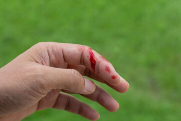 A man's fingers was injured and bleeding due to accident.