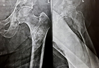 2 view xray with high probability of subtrochanteric, trochanteric fissure fracture, and malignancy...
