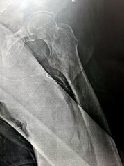 Plain x-ray with high probability of subtrochanteric, trochanteric fissure fracture, and malignancy...