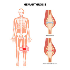 Hemarthrosis in the synovial joint