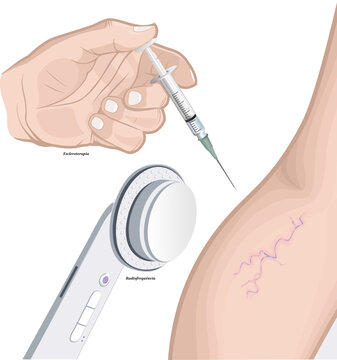 Escleroterapia, ou "aplica&ccedil;&atilde;o", &eacute; um tratamento para eliminar ou diminuir as veias a partir da aplica&ccedil;&atilde;o de uma subst&acirc;ncia diretamente no local