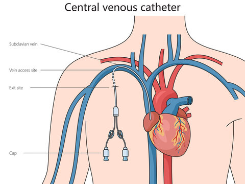 Central venous catheter structure diagram hand drawn schematic raster illustration. Medical science educational illustration