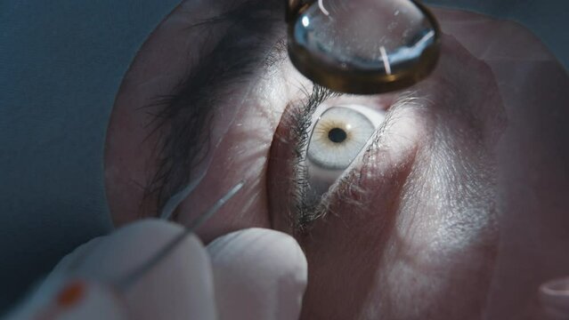 Laser vision correction. Patient and surgeon in operating room during ophthalmic surgery or diagnostics. Open eye. Patient under sterile cover. Close-up