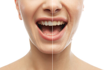 Oral care and hygiene. Half-face comparison with smile showing healthy and white teeth. Collage....