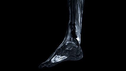 MRI FOOT scan Sagittal view T2 Fat suppression  technique   for diagnostic tendon injury. - obrazy, fototapety, plakaty