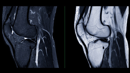 Magnetic resonance imaging or MRI of  knee joint. This diagnostic technique is crucial for...
