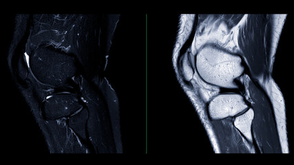 Magnetic resonance imaging or MRI of  knee joint. This diagnostic technique is crucial for...