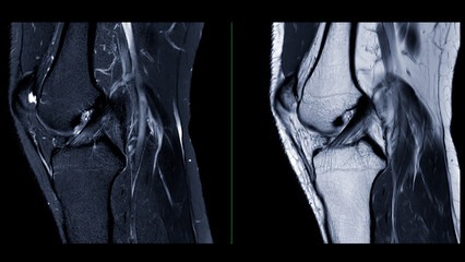 Magnetic resonance imaging or MRI of  knee joint. This diagnostic technique is crucial for assessing ligaments, cartilage, and identifying issues like tears or inflammation. - obrazy, fototapety, plakaty