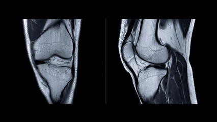 Magnetic resonance imaging or MRI of  knee joint. This diagnostic technique is crucial for...