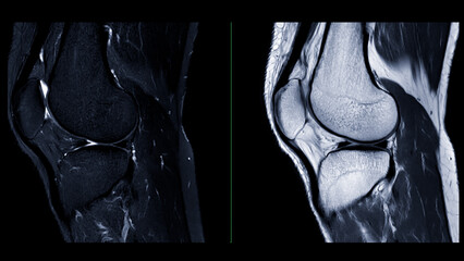 Magnetic resonance imaging or MRI of  knee joint. This diagnostic technique is crucial for assessing ligaments, cartilage, and identifying issues like tears or inflammation. - obrazy, fototapety, plakaty