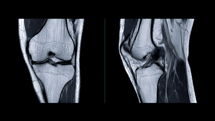 Magnetic resonance imaging or MRI of  knee joint. This diagnostic technique is crucial for...