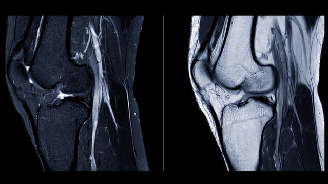 Magnetic resonance imaging or MRI of  knee joint. This diagnostic technique is crucial for assessing ligaments, cartilage, and identifying issues like tears or inflammation.