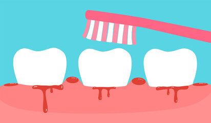 Brushing teeth with bleeding on gum vector illustration. Gingivitis. Periodontitis or gum disease concept.
