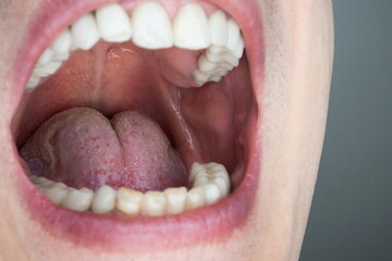 Caucasian male open oral cavity, close up shot