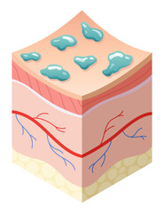 Skincare medical concept. Problems in cross-section of human skin horizontal layers structure. Anatomy illustrative model unhealthy layer of skin