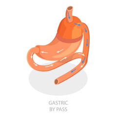 3D Isometric Flat Vector Illustration of Types Of Bariatric Surgery, Sleeve Gastrectomy. Item 2