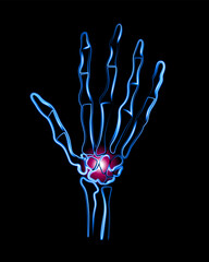 Obraz premium Vector isolated illustration of wrist pain. Hand with localization of pain in the wrist.