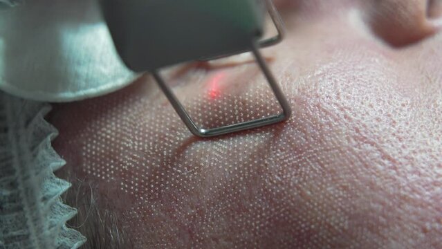 Extreme close up shot of Beautician cosmetologist doing procedure fractional microneedle mesotherapy rejuvenation with laser technology. Hardware cosmetology in clinic salon for client.