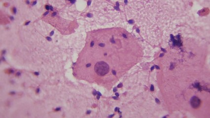 Semen. Qualitative and quantitative visual, physico-chemical and microscopic analysis of male semen (ejaculate). 1000x magnification. Oligozoospermia. Azoospermia