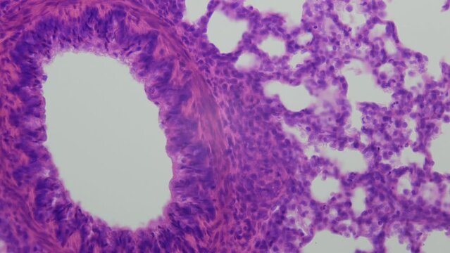 Lungs. Microanatomy. 400x times magnification. Porous structure of human lungs under the microscope in detail. Diseases of the respiratory system.Lung biopsy. Cytologic and histologic analysis. Cancer