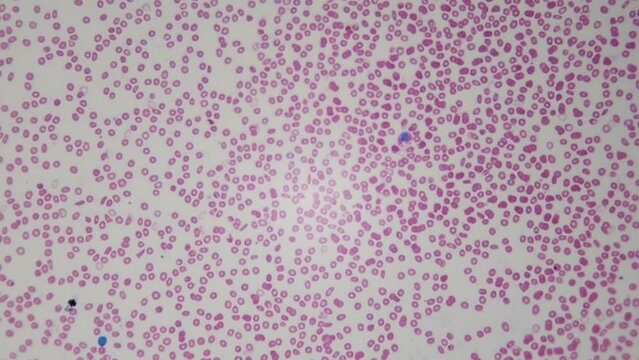 Blood analysis under microscope. Main method of determining general condition of body and helping in diagnosis of huge number of diseases. 100x magnification. RBC and WBC